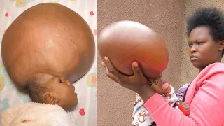 This Baby’s Head Can’t Stop GROWING - Doctors Say It’s Impossible..😶