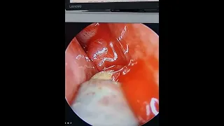 nasal bleeding mass excision.dr jalil mujawar