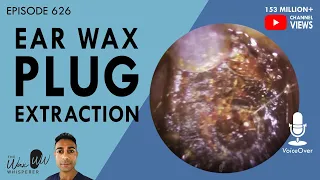 626 - Ear Wax Plug Extraction