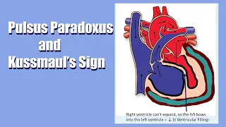 Pulsus Paradoxus & Kussmaul's Sign: A Sign of Heart Trouble!  A Live Lecture...