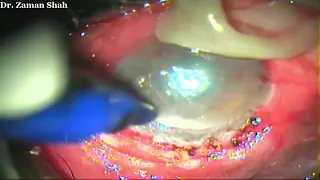 Fibrin glue and triple layer of amniotic membrane in case of peripheral ulcerative keratitis