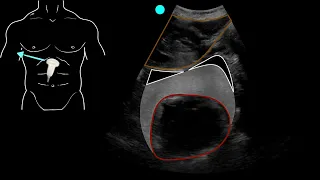 POCUS - Positive EFAST exam with hemopericardium