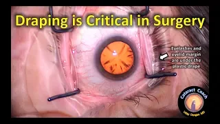 Cataract Surgery Draping is Critical for Success