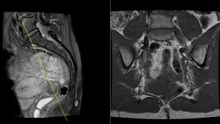 Common cysts in the vagina, labia, and spine on MRI