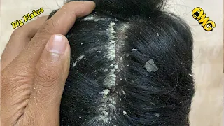 DRY SCALP !! Big Flakes Dandruff Scratching Satisfying Video #862