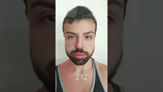 Hair Transplant Time Lapse - Day 1 to Day 347 - 1 Year Result