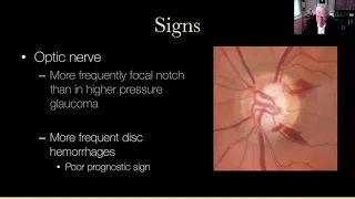 Lecture: General Principles of Glaucoma Management