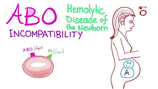 ABO Incompatibility And Hemolytic Disease Of The Newborn (HDN)