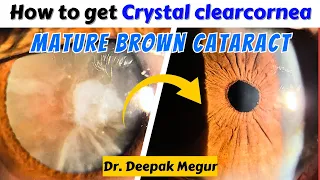 How to get a crystal-clear cornea in a mature brown cataract (Principles) - Dr. Deepak Megur