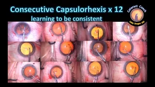 12 consecutive Capsulorhexes in Cataract Surgery