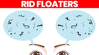 Eye Floaters: What Are They & How to Get Rid of Them