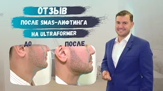 Smas-лифтинг на ULTRAFORMER | Реальный результат и отзыв о процедуре