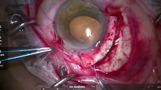 Iridocyclectomy for iris melanoma