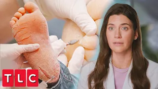 Incredibly Deep Fissures: Dr. Sarah Breaks Out the Medical Dremel | My Feet Are Killing Me