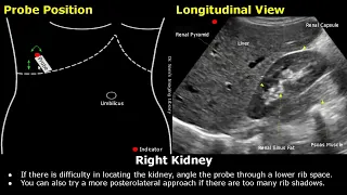 Kidney Ultrasound Probe Positioning | Transducer Placement & Scanning | Abdominal USG | Sonography