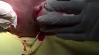 Womans 20 Year Old Cyst Finally Gets Popped