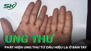 Phát Hiện Ung Thư Từ Dấu Hiệu Lạ Ở Bàn Tay  I SKĐS