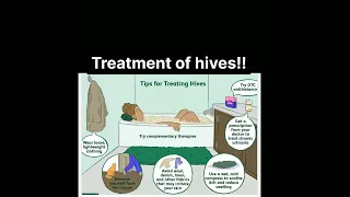 Treatment of hives #short #doctor