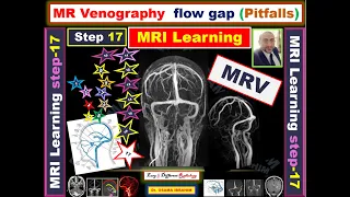 MRV Flow GAP pitfalls; Venous sinus thrombosis versus hypoplasia (MRI learning- Episode 17 )