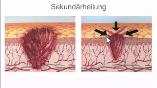 Grundlagen der Wundheilung - Teil I