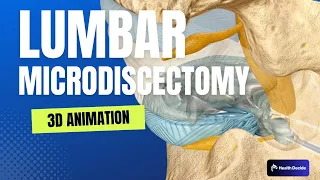 Lumbar Microdiscectomy - 3D Animation