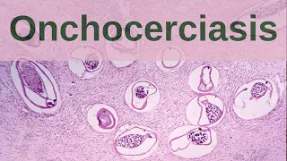 What is Onchocerciasis? - Pathology mini tutorial