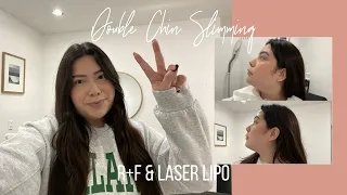 Laser Lipo — Double Chin Slimming