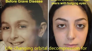 Orbital Decompression Surgery on Teenager with Graves Disease Bulging Eyes