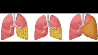 MALFORMAÇÃO ADENOMATÓIDE CÍSTICA PULMONAR - MAC - DIAGNÓSTICO E CONDUTA PRÉNATAL - SARRAFF SAÚDE