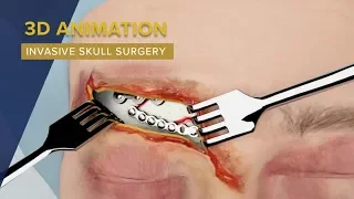 3D Animation Used To Display ORIF Skull Surgery