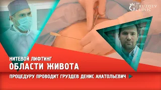 Нитевой лифтинг области живота