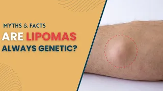 Are Lipomas always genetic? | Lipoma Treatment in Delhi | Lipoma Surgery in Delhi | @SkinQure