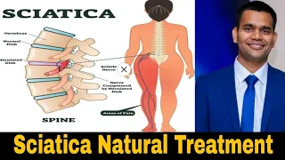 Sciatica Treatment - Cure Sciatica Nerve Pian Naturally | Dr. Vivek Joshi