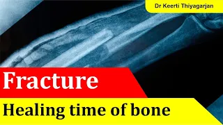 Healing time of bone fracture in Tamil