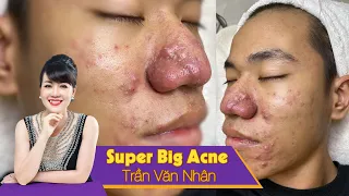 Remove super bis acne| Điều trị mụn hiệu quả số 1 TPHCM| Hiền Vân Spa | Trần Văn Nhân |538