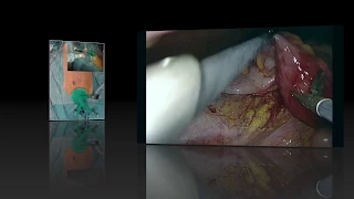 Suprapubic single port ileocaecal resection for complicated Crohn’s disease