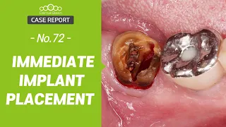 #47 Immediate implant placement [Dr. Cho Yongseok]