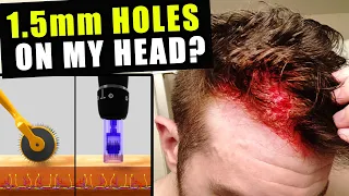 I Cut Thousands Of 1.5 Millimetre Holes In My Head Every Week To Prevent Hair Loss