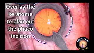 overlay keratome to plan out the phaco incision in cataract surgery