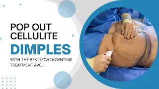 POP OUT CELLULITE DIMPLES WITH THE BEST LOW DOWNTIME TREATMENT AVELI | Dr. Jason Emer