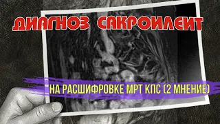 Правосторонний САКРОИЛЕИТ на МРТ расшифровке (2 мнение). Крестцово-подвздошное сочленение воспаление