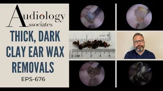 THICK, DARK CLAY EAR WAX REMOVALS - EP676