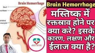 Brain Hemorrhage। ब्रेन हेमोरेज होने के बाद क्या करे? कारण, लक्षण और ईलाज।