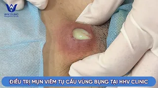 ĐIỀU TRỊ MỤN VIÊM TỤ CẦU VÙNG BỤNG, KHÔNG ĐỂ LẠI SẸO VÀ THÂM TẠI PHÒNG KHÁM DA LIỄU HHV CLINIC