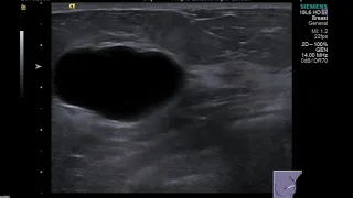Breast Ultrasound   cyst