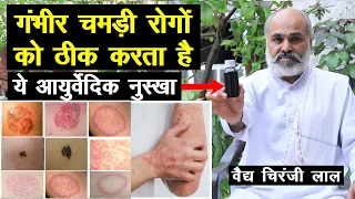 गंभीर चमड़ी रोगों को ठीक करता है ये आयुर्वेदिक नुस्खा, 100% कारगर Skin Disease Natural Treatment