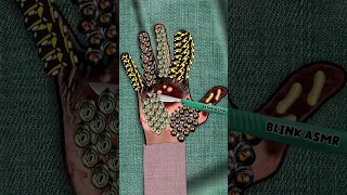 ASMR removing ticks and maggots from hand | severely injured animation #asmr #blinkasmr #animation