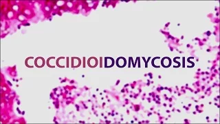Coccidioidomycosis (Valley Fever) | Pediatric Grand Grounds - Mattel Children's Hospital UCLA