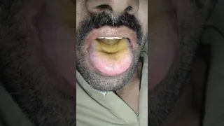 Tongue Fasciculations..Case detail given in Comment.