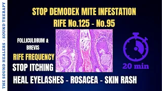 DEMODEX ➤ Stop Itching ➤ Mite Infestation ➤ Heal Eyelashes ➤ Dermatitis ➤ Skin Rash ➤ Sound Therapy